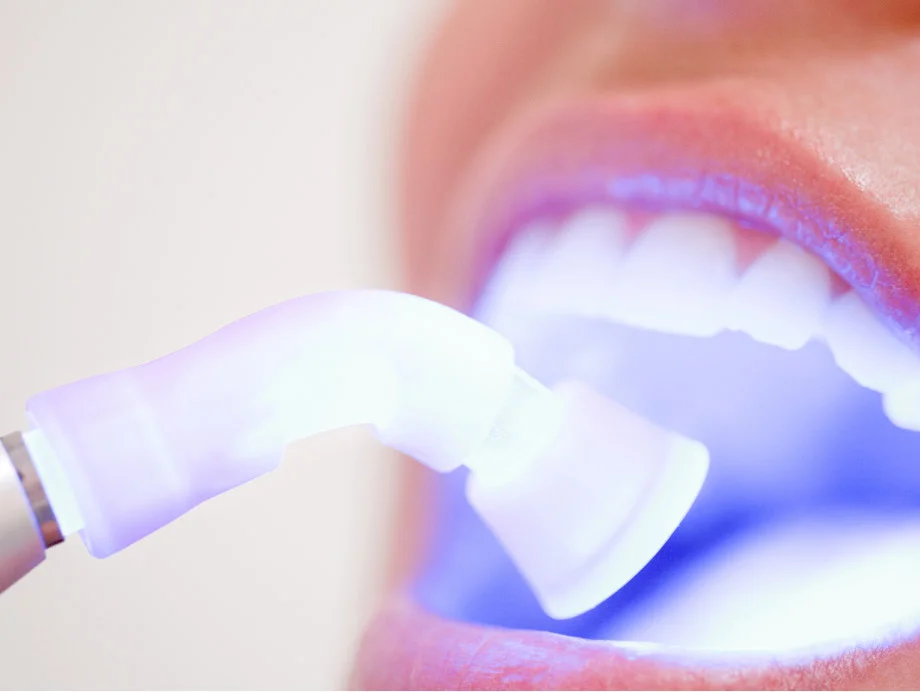 Blanqueamiento de dientes sensibles
