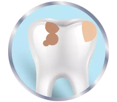 Tooth that is dirty from plaque
